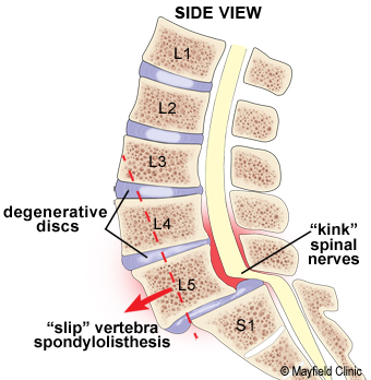 Spondylolistesis, verschoven wervels van de onderrug